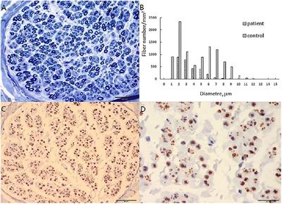 Peripheral Nervous System Involvement in Late-Onset Cobalamin C Disease?